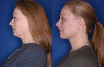 53 year old female 1 month post op from an upper blepharoplasty, extended deep plane facelift, and perialar lip lift.