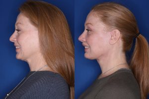 53 year old female 1 month post op from an upper blepharoplasty, extended deep plane facelift, and perialar lip lift.