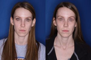 31 year old female 7 weeks post op from a cosmetic revision rhinoplasty
