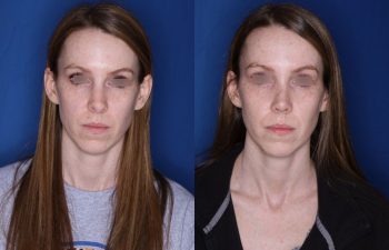 31 year old female 7 weeks post op from a cosmetic revision rhinoplasty