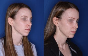 31 year old female 7 weeks post op from a cosmetic revision rhinoplasty