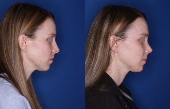 31 year old female 7 weeks post op from a cosmetic revision rhinoplasty