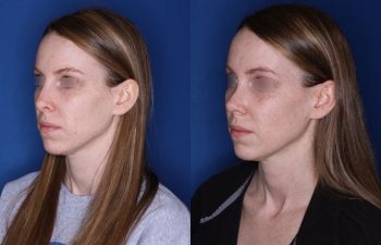 31 year old female 7 weeks post op from a cosmetic revision rhinoplasty