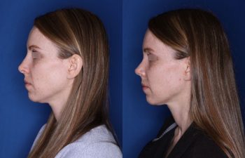 31 year old female 7 weeks post op from a cosmetic revision rhinoplasty