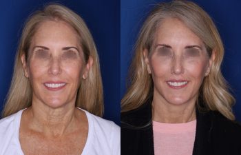 56 year old female 3.5 months post op from an extended deep plane facelift and perialar lip lift