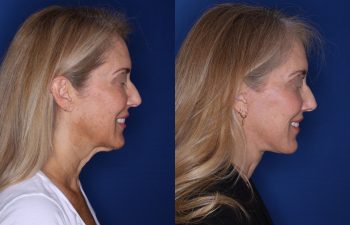56 year old female 3.5 months post op from an extended deep plane facelift and perialar lip lift