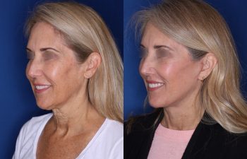 56 year old female 3.5 months post op from an extended deep plane facelift and perialar lip lift