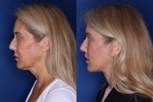 56 year old female 3.5 months post op from an extended deep plane facelift and perialar lip lift