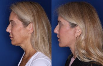 56 year old female 3.5 months post op from an extended deep plane facelift and perialar lip lift