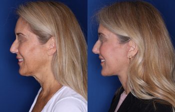 56 year old female 3.5 months post op from an extended deep plane facelift and perialar lip lift