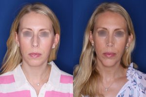 39 year old female 4.5 months post op from cosmetic rhinoplasty with a chin implant