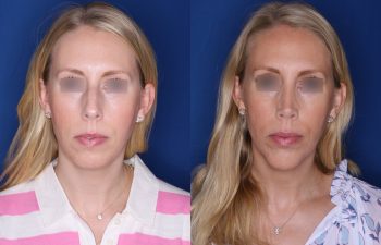 39 year old female 4.5 months post op from cosmetic rhinoplasty with a chin implant