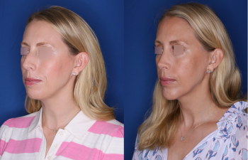 39 year old female 4.5 months post op from cosmetic rhinoplasty with a chin implant