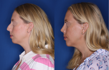 39 year old female 4.5 months post op from cosmetic rhinoplasty with a chin implant