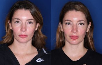 34 year old female 7 months post op from lower eyelid blepharoplasty with fat transpositions