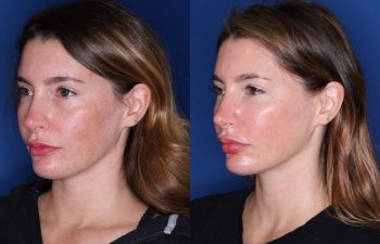 34 year old female 7 months post op from lower eyelid blepharoplasty with fat transpositions
