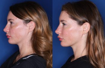 34 year old female 7 months post op from lower eyelid blepharoplasty with fat transpositions