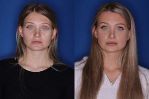 25 year old female 5.5 months out from a cosmetic rhinoplasty