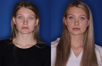 25 year old female 5.5 months out from a cosmetic rhinoplasty