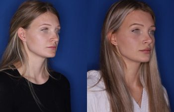 25 year old female 5.5 months out from a cosmetic rhinoplasty