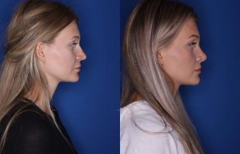 25 year old female 5.5 months out from a cosmetic rhinoplasty