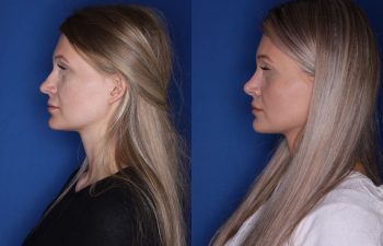 25 year old female 5.5 months out from a cosmetic rhinoplasty