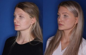 25 year old female 5.5 months out from a cosmetic rhinoplasty
