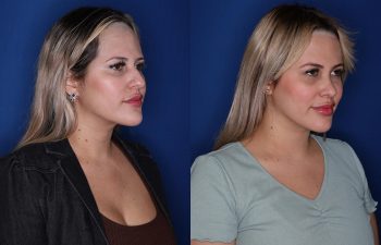 31 year old female six weeks following her cosmetic rhinoplasty