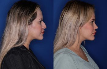 31 year old female six weeks following her cosmetic rhinoplasty