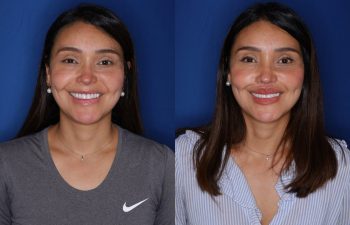 38 year old female 2 months following removal of a silicone lip implant and revision lip lift using the perialar lip lift