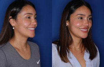 38 year old female 2 months following removal of a silicone lip implant and revision lip lift using the perialar lip lift