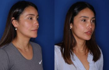 38 year old female 2 months following removal of a silicone lip implant and revision lip lift using the perialar lip lift