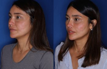 38 year old female 2 months following removal of a silicone lip implant and revision lip lift using the perialar lip lift