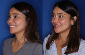 38 year old female 2 months following removal of a silicone lip implant and revision lip lift using the perialar lip lift