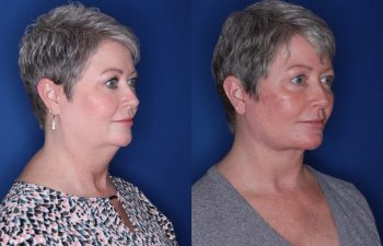 54 year old patient 4 months following an extended deep plane facelift with buccal fat removal