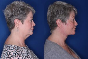 54 year old patient 4 months following an extended deep plane facelift with buccal fat removal