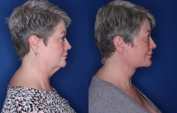 54 year old patient 4 months following an extended deep plane facelift with buccal fat removal