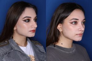 21 year old 3.5 months post op from cosmetic rhinoplasty