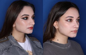 21 year old 3.5 months post op from cosmetic rhinoplasty