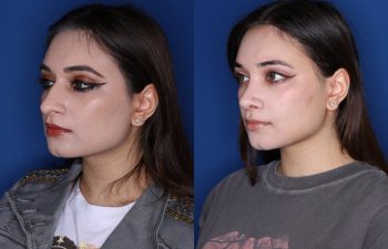 21 year old 3.5 months post op from cosmetic rhinoplasty