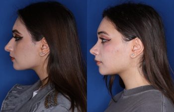 21 year old 3.5 months post op from cosmetic rhinoplasty