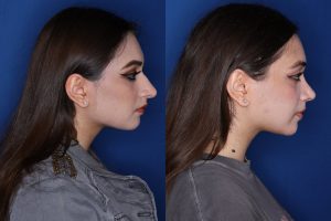 21 year old 3.5 months post op from cosmetic rhinoplasty
