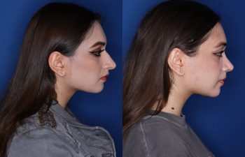 21 year old 3.5 months post op from cosmetic rhinoplasty