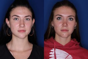 23 year old female 1 year post op from a cosmetic rhinoplasty