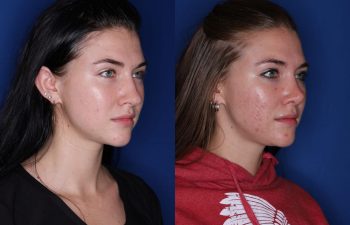 23 year old female 1 year post op from a cosmetic rhinoplasty