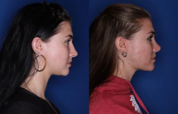 23 year old female 1 year post op from a cosmetic rhinoplasty