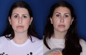 39 year old female 6 months post op from a cosmetic rhinoplasty, lateral temporal brow lift, and upper blepharoplasty