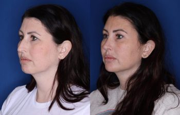 39 year old female 6 months post op from a cosmetic rhinoplasty, lateral temporal brow lift, and upper blepharoplasty