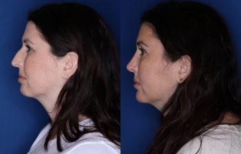 39 year old female 6 months post op from a cosmetic rhinoplasty, lateral temporal brow lift, and upper blepharoplasty