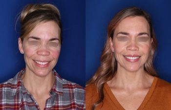 47 year old patient 1+ year post op from a perialar lip lift